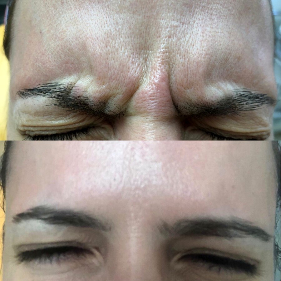 Botoks glabele — pre i posle tretmana u Dentani