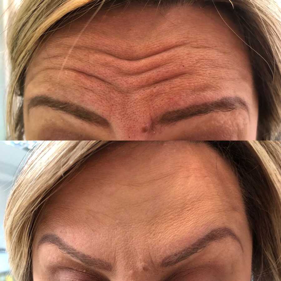 Botoks čela — pre i posle tretmana u Dentani