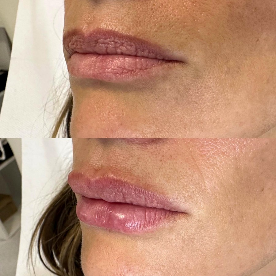 Hijaluronski fileri usana — pre i posle tretmana u Dentani