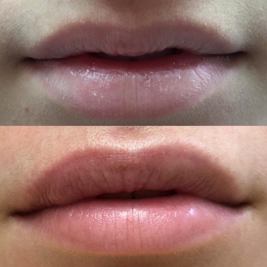 Prirodno oblikovanje usana — pre i posle tretmana u Dentani